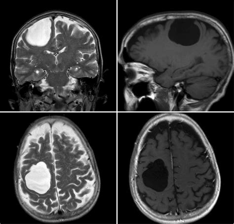 Upper left, axial T2 MRI shows a hyperintense cystic mass over right... | Download Scientific ...