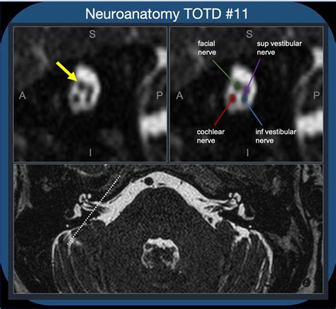 Neuroanatomy TOTD #11🧵 ️intracanalicular facial nerve. IAC cross section ️4 nerves; ant-sup ...