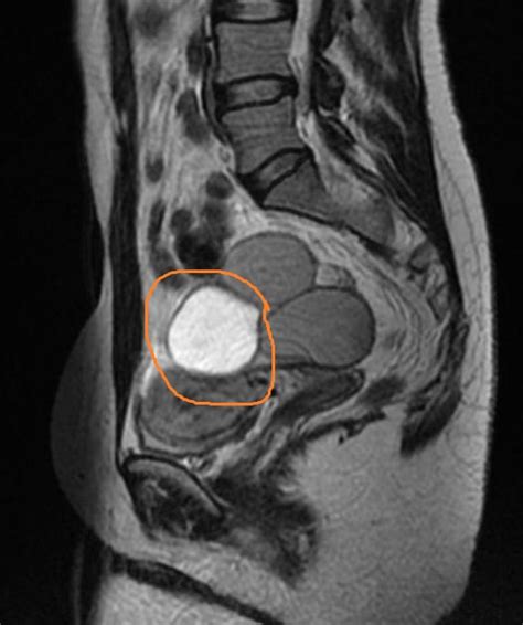 Endometriosis MRI - wikidoc