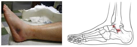 Ankle Sprain | Dr. Babajide A. Ogunlana, DPM, FACFAS Wes