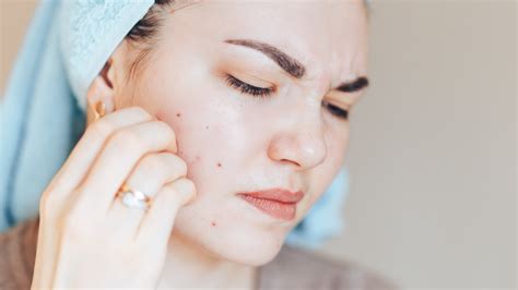 How To Tell If You Have Acne Excoriée