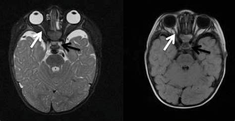 Axial Tx and Ty MRI scans showing complete absence of the optic chiasm ...