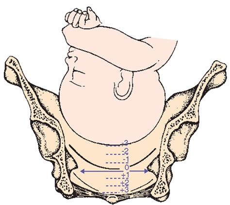 Stations of the fetal head. This diagram shows the relationship of the ...