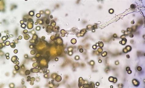 Microscopic image of Urinalysis. Abnormal urine exam. Uric acid crystals. 13675255 Stock Photo ...