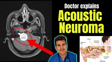 Doctor explains Acoustic Neuroma - including symptoms, investigations ...