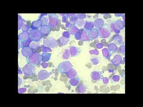 Lab or Diagnostic Findings: Auer Rods (Acute Myelogenous Leukemia, Promyelocytic (M3) Type ...