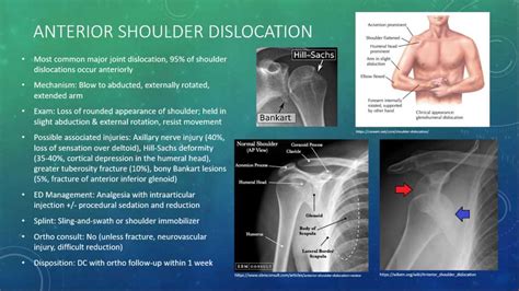 shoulder dislocation,WHAT TO KNOW?