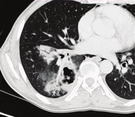 -Chest CT showing small centrilobular nodules with tree-in-bud ...