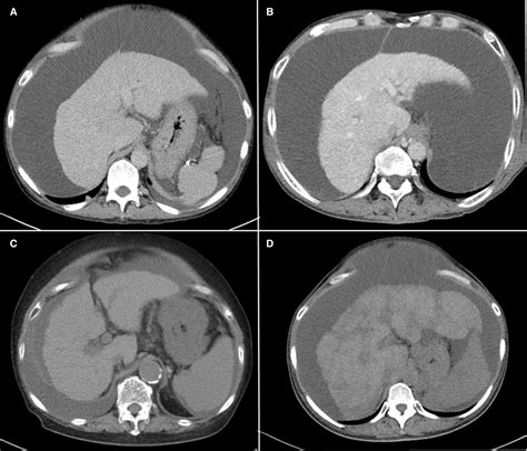 First reports of clinical effects of transjugular intrahepatic ...