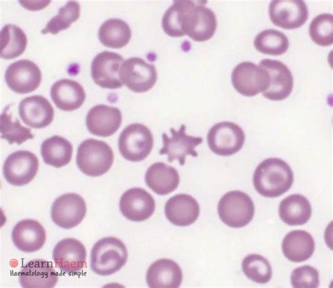 Acanthocytes - LearnHaem | Haematology Made Simple