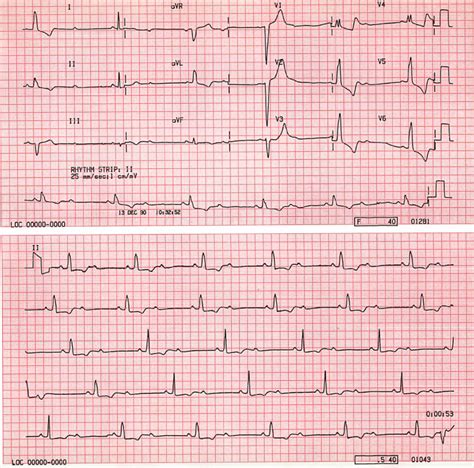 Case B6. Second Degree AV Block, 2 :1 Block. St Emlyn's ECG Library ...