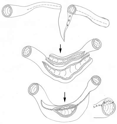 A Comprehensive Review of Strictureplasty Techniques in Crohn’s Disease ...