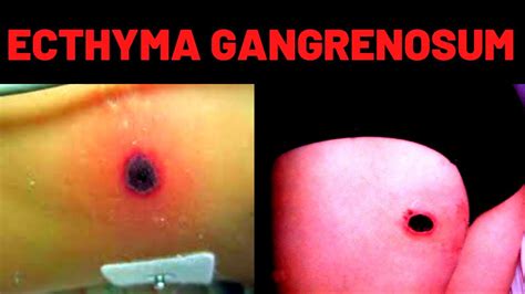 WHAT IS ECTHYMA GANGRENOSUM? Causes, Symptoms - YouTube