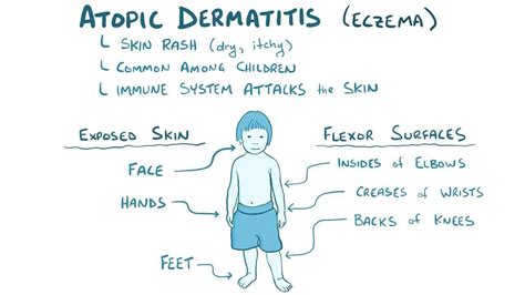 Atopic Triad: What Is It, Causes, and More | Osmosis