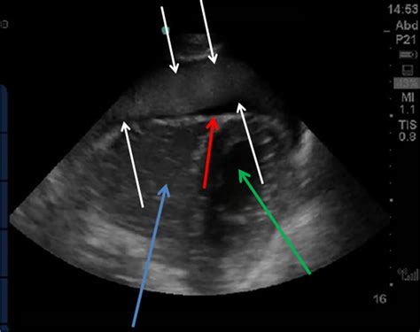 Dr. Smith's ECG Blog: 30 Year Old with Cardiac Arrest, PEA, then Cardiac Ultrasound