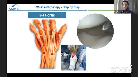 Wrist Arthroscopy: Step by Step - YouTube