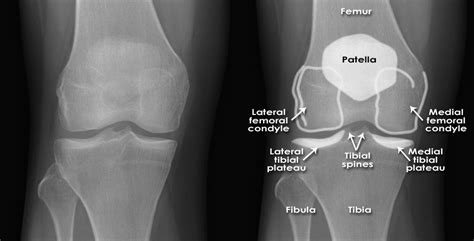 Trauma X-ray - Lower limb - Knee