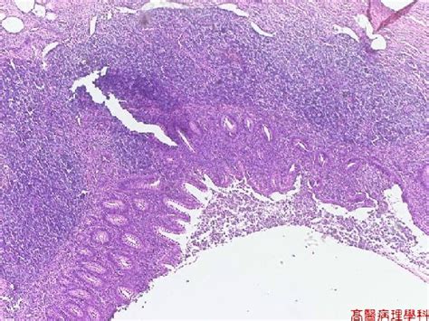 Acute Appendicitis Histology