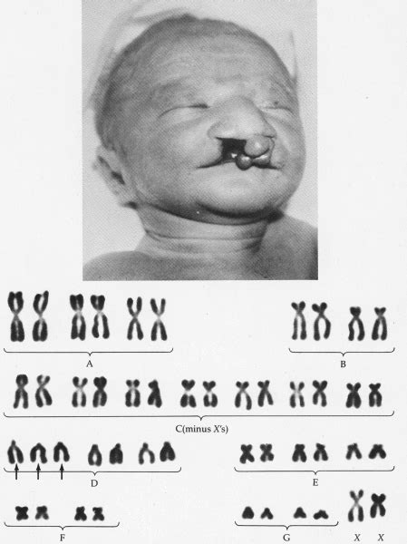 Rock your chromosome: PATAU SYNDROME