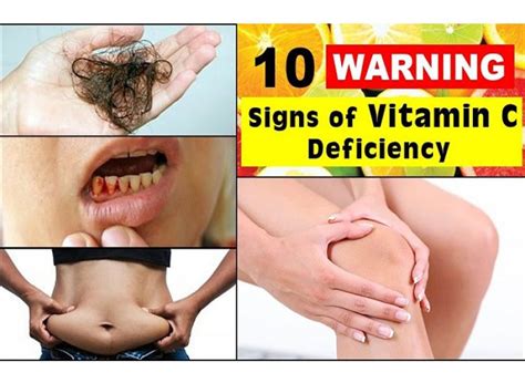 The Warning Signs of Vitamin C Deficiency and How to Treat It | by Your Pathology | Medium