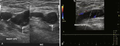 Venous Thrombosis Ultrasound