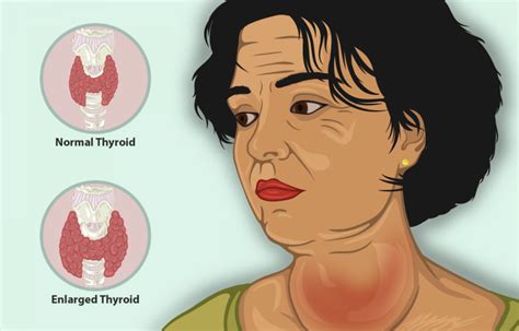 What is Goiter and Natural Goiter Treatments to Consider