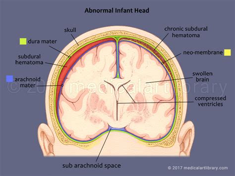 Shaken Baby - Subdural Hematoma - Medical Art Library