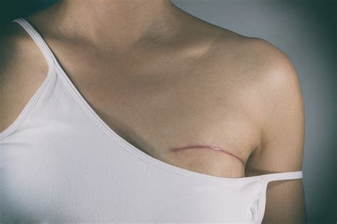 What to Know About Breast Cancer-related Lymphedema | Inspira Health