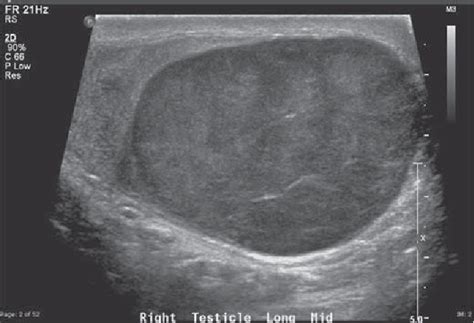 Figure 1 from Testicular Tumor Ultrasound Characteristics and Association with Histopathology ...