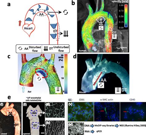 Site-specific disturbed blood flow in the aorta. Flow separation in the ...