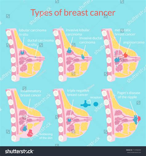 8,381 Cancer Types Images, Stock Photos & Vectors | Shutterstock