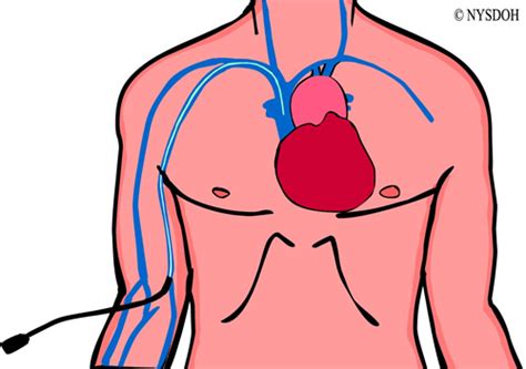 Central Line Associated Blood Stream Infection (CLABSI) Prevention - Healthcare Associated ...