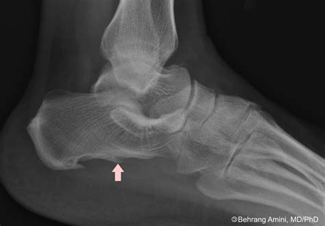 Roentgen Ray Reader: The Long Plantar Ligament Enthesophyte