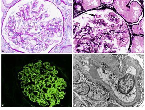 a Pathology of membranous nephropathy. The glomerular basement... | Download Scientific Diagram