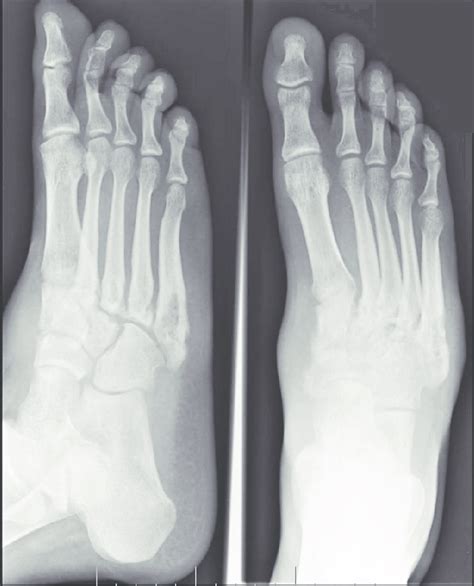 Xray Normal Foot