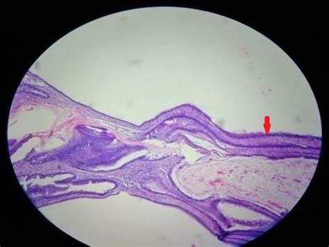 Journal of Postgraduate Gynecology & Obstetrics: Borderline Mucinous ...