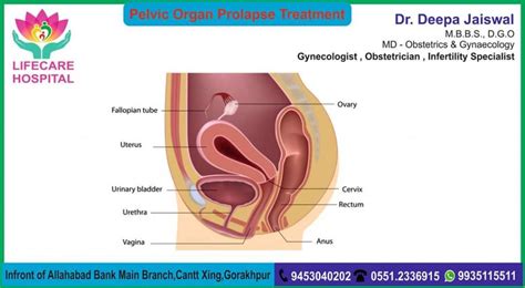 Pelvic Organ Prolapse Treatment - LIFECARE HOSPITAL