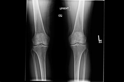 Case Study: Bilateral Knee Pain Due to Osteoarthritis - Clinical Pain Advisor