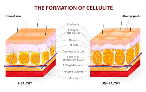 The Reason Why Liposuction Is Not A Treatment For Cellulite - Feel Good Laser and Skin