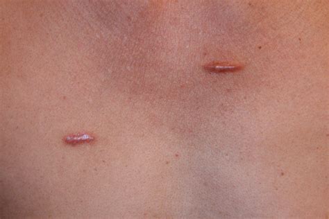 Keloid scar treatment [Is it a lost cause?] - SkinPractice