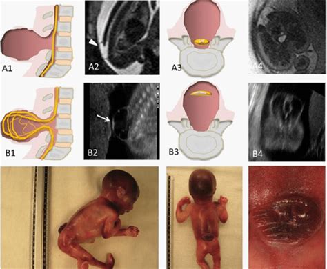 Myelomeningocele and meningocele. Schematic representations (A1, A3 ...