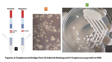 Cryptococcal Antigen Test: Introduction, Principle, Test Procedure, Result