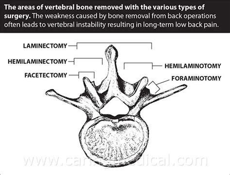 Post Lumbar and Cervical Laminectomy Syndrome treatment options