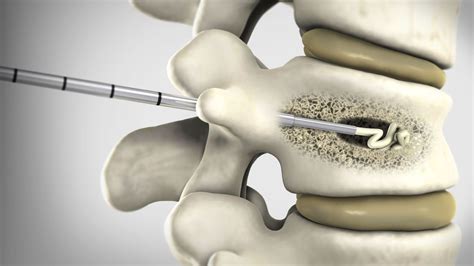 Kyphoplasty Procedure | UNIMEDIKS - Restoring Vertebral Height and Stability