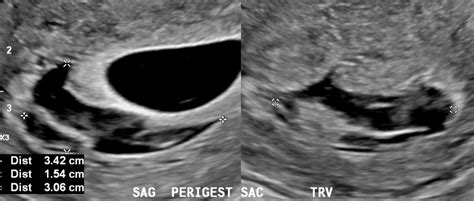 Subchorionic Hemorrhage - Sononotes