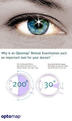 9 Optomap Retinal Scan ideas | retinal scan, eye health, comprehensive ...