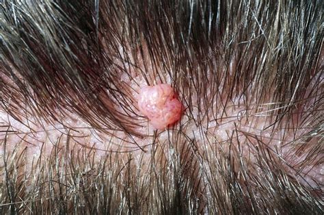 Close-up of a benign mole on scalp of young man - Stock Image - M220/0107 - Science Photo Library