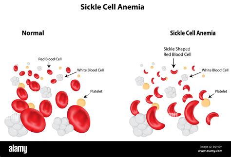 Sickle Cell Anemia Stock Vector Image & Art - Alamy