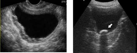 Cystitis image on ultrasound | Vinmec