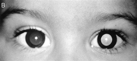 Anisometropic Amblyopia case photos